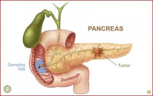 pancreas-cancer_Med.World