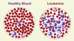 leukemia