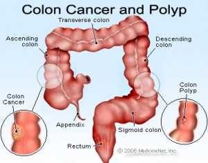 Colon cancer n polyp_MedincineNet