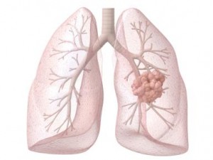 Lung Cancer_lungcancer.about.com_iStock_000016025129_Large