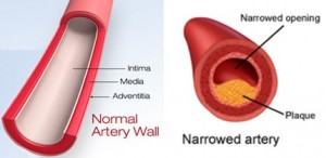 Norm & Narrowed As_Heart.org & Vitalscan