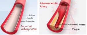 Norm & Artheroma Arteries_AHA